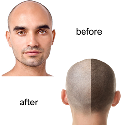 Zeige Details für Scalp - Pigmentierung - Mikro - Haar - Ausbildung Bild von Scalp - Pigmentierung - Mikro - Haar - Ausbildung